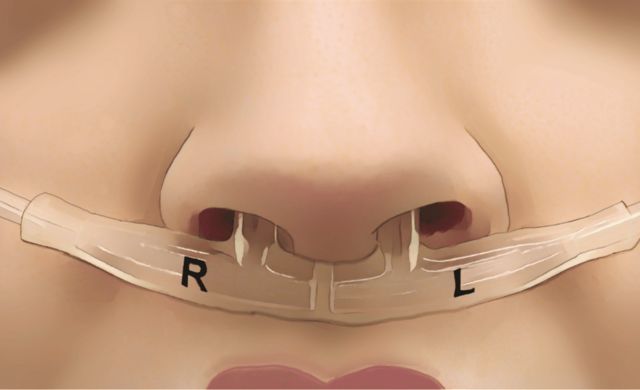Nasal Breathing is Essential to Cardiovascular Health